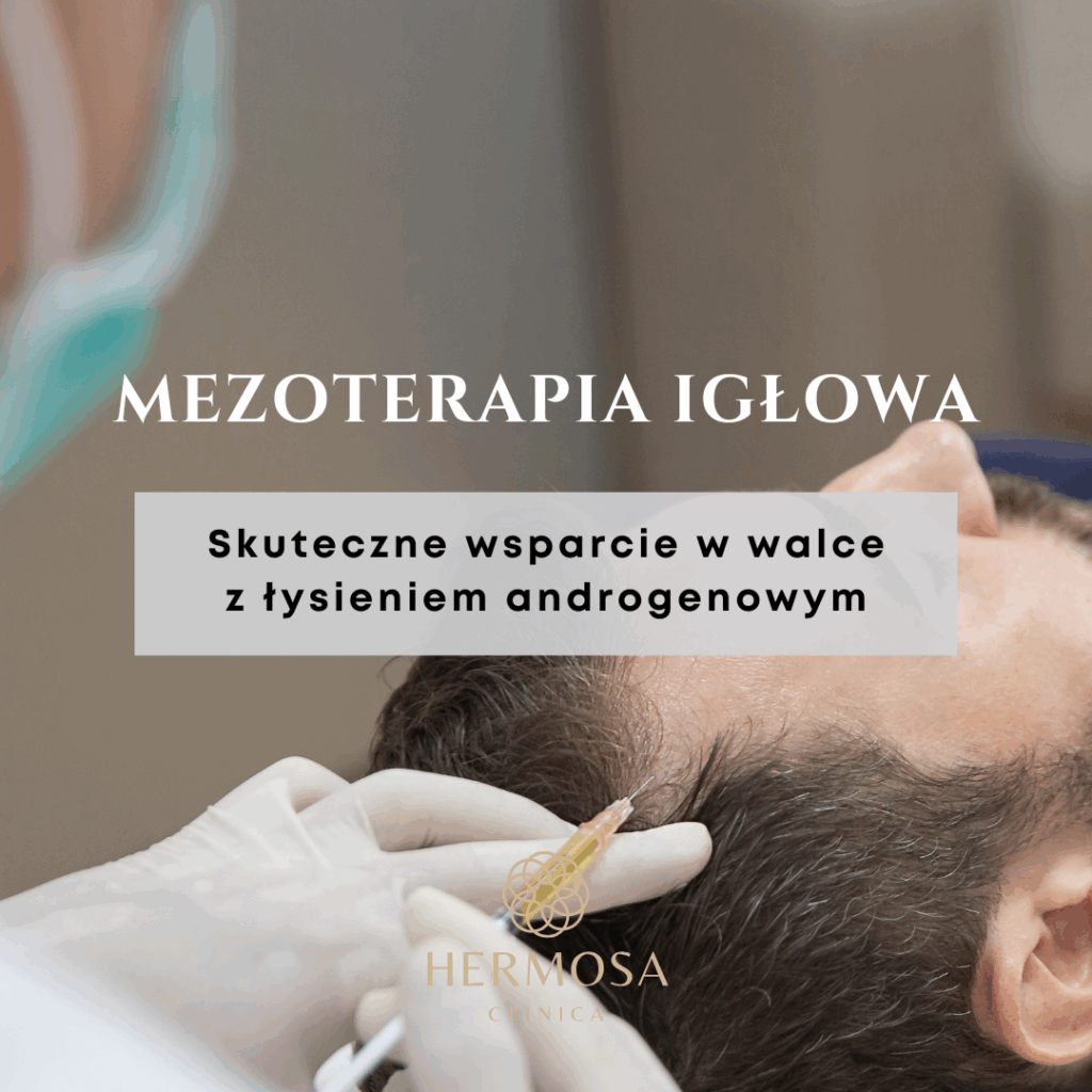 Mezoterapia igłowa – skuteczne wsparcie w walce z łysieniem androgenowym