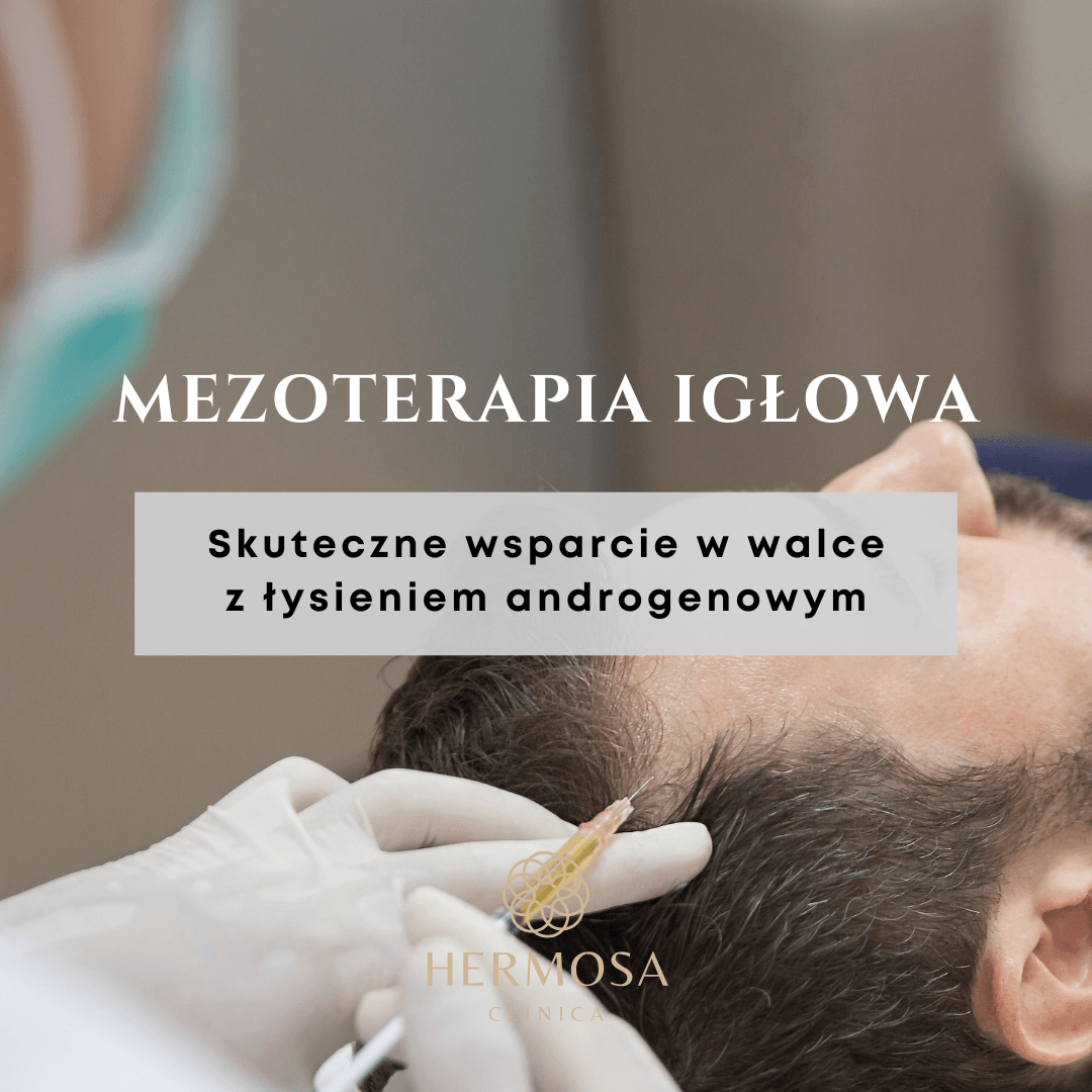 Mezoterapia igłowa – skuteczne wsparcie w walce z łysieniem androgenowym