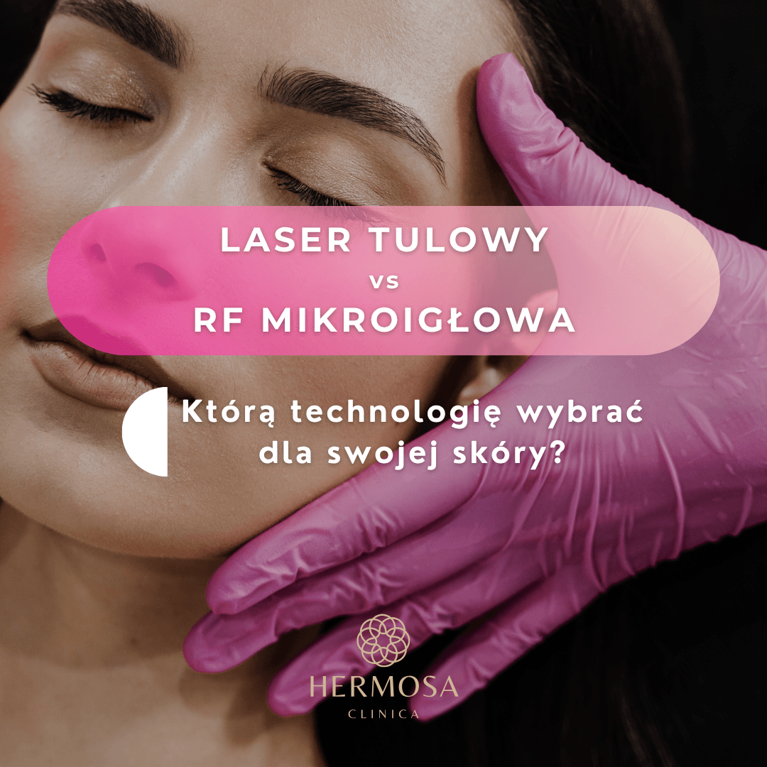Laser tulowy vs RF mikroigłowa – którą technologię wybrać dla swojej skóry?